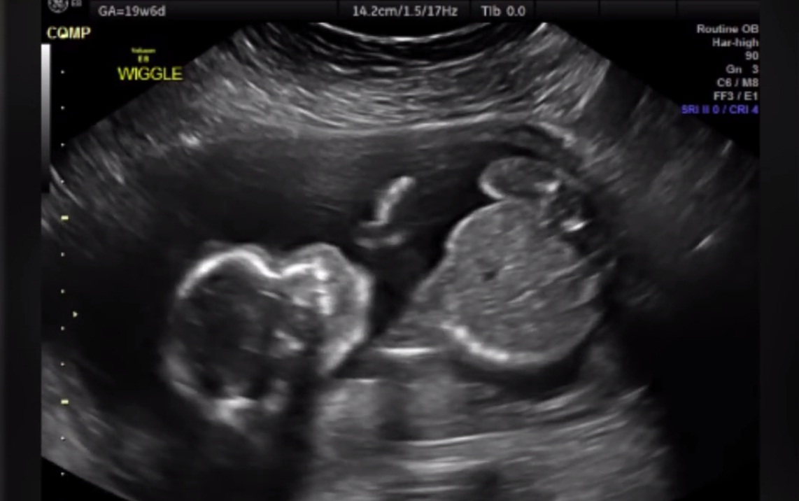 Baby Punches Own Head In Ultrasound